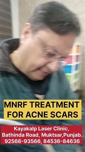 Ice Pick Scars? MNRF Alone Won't Fix It | What Actually Works #acnescars #skintreatment #laserclinic