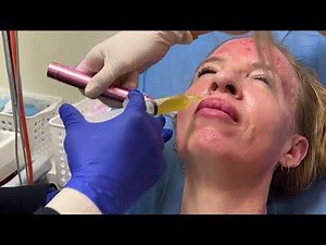 Platelet-Rich Plasma (PRP) Treatment Experience: Benefits and Process || #PRP #AntiAging