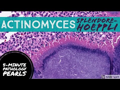 Actinomyces (Actinomycotic Mycetoma) with Splendore-Hoeppli phenomenon: 5-Minute Pathology Pearls