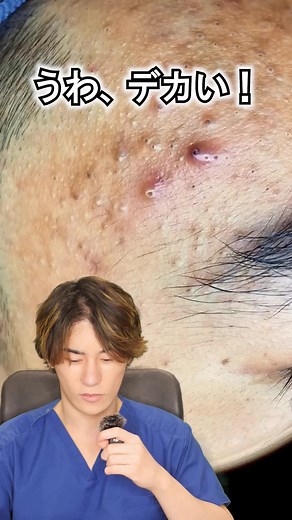 こんな毛穴の黒ずみ見たことない😱#あきよし先生 #毛穴の黒ずみ #角栓除去 #acnetreatment