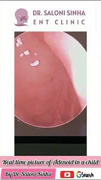 Watch What This Doctor Uncovers During Endoscopic Examination of a Child's Adenoid Hypertrophy!