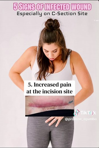 5 Signs of an Infected C-Section Wound