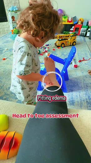 Cómo documentar CAP REFILL y EDEMA en tu evaluación