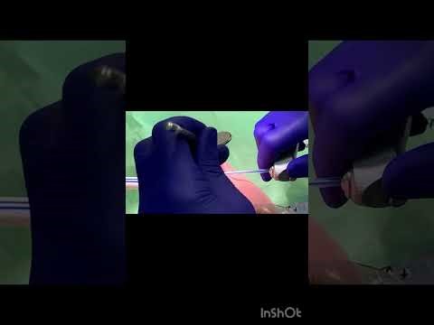 Bonding fixed retainer wire