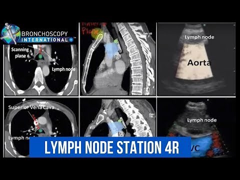 BronchAtlas EBUS Identification Lymph Node Station 4R