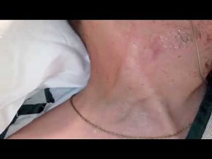 Jugular Venous Distension Example