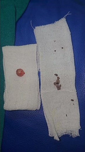 Sebaceous Cyst Removal