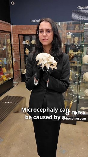 Understanding Microcephaly: Features and Insights