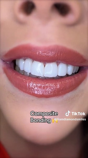 Smile upgrade with 6 composite veneers placed in a single visit #compositeveneers #cosmeticdentistry #smiledesign #compositebonding