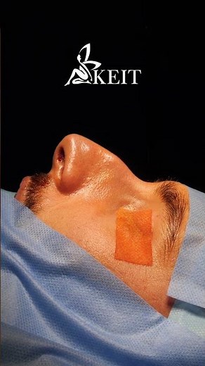 Male Rhinoplasty Transformation | Real Patient Before and After Results