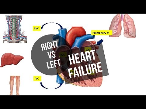 Heart Failure | Right sided vs. Left sided | Cor Pulmonale | ASPIRE MDS