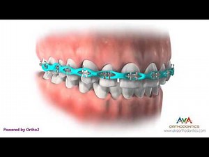 Orthodontic Treatment for Spacing - Different Stages