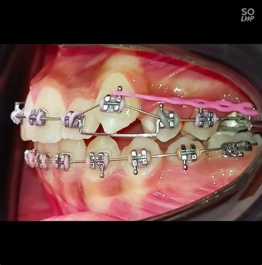 piggyback technique orthodontics #dentistry
