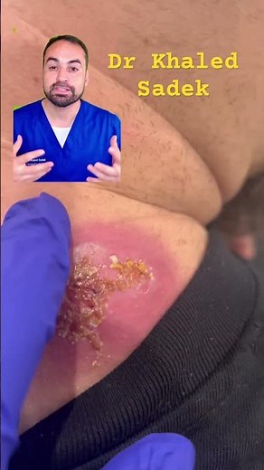 Infected abscess explained #skincare dr khaled sadek
