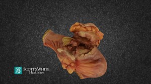 Jejunum Cancer 10891 - 3D model by Scott & White Moulage Project (@swmoulage)