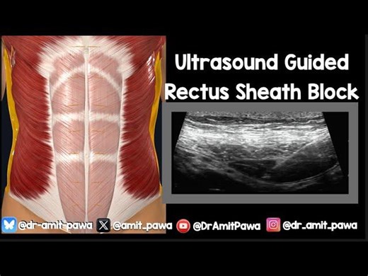 New Rectus Sheath Block Video with Actual Block Included! | Professor Amit Pawa BSc(Hons) MBBS(Hons) FRCA ESRA-DRA