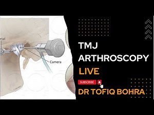 TMJ Arthroscopy Video -Surgical Video demonstration #tmjdisorder,#tmjfamilia #tmd #DrTofiqBohra