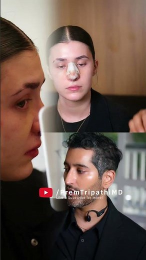 Rhinoplasty Recovery 101