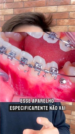 Self-ligating braces without rubber bands
