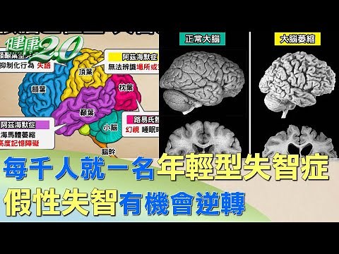 每千人就一名年輕型失智症 假性失智有機會逆轉 健康2.0