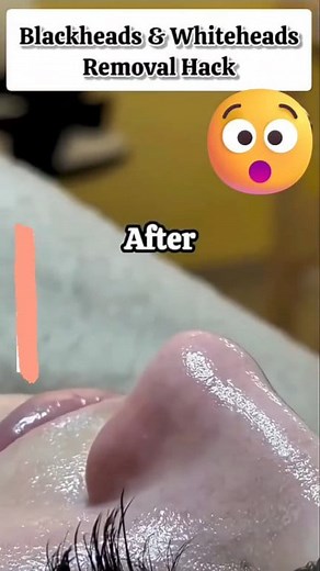 Easy Way To Remove Blackheads Naturally At Home | Blackheads Removal Pack 😱 Get Glowing Skin . . . #blackheads #whiteheads #glowingskin #skincare #reelsvideoシ #reelsviralシ #fbreelsfypシ゚ #fbreelsvideo #reelschallenge | Back to nature remedy