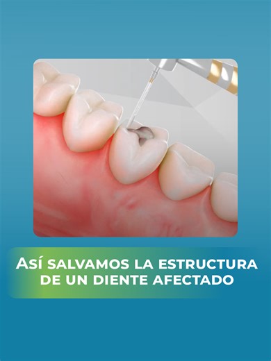 Un empaste dental sirve para reconstruir la estructura del diente con precisión. Después de preparar la zona, se coloca un material restaurador diseñado para adaptarse perfectamente a la forma natural del diente. Por eso no se trata simplemente de “rellenar”, sino de devolver resistencia, anatomía y función. Este material se moldea cuidadosamente para integrarse con tu mordida, luego se endurece y se pule, logrando una superficie firme, estética y funcional. Lo más importante es que esta restaur