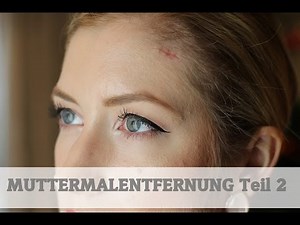 MUTTERMALENTFERNUNG Teil 2 | Update
