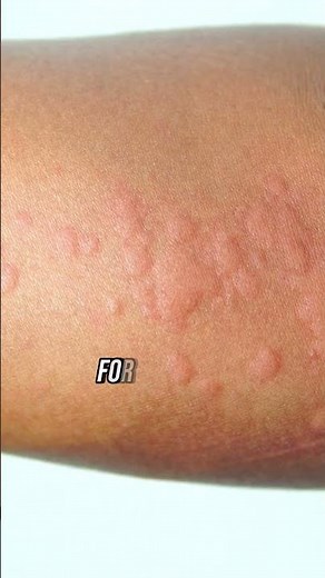 Which Is Better Blood Test Or Scratch Test?