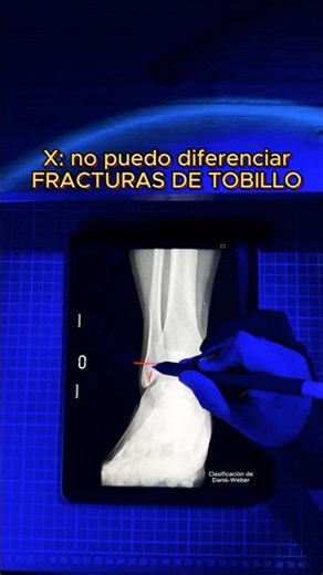 Clasificación de fracturas de tobillo‼️👀🦴🛠