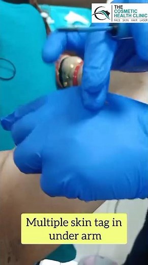 ✨ Underarm Skin Tag Removal ✨