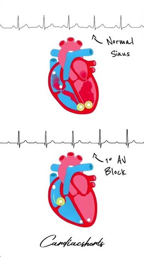 Heart's Conduction in Normal Sinus Rhythm vs First Degree AV Block #shorts #ecg #cardiology #anatomy