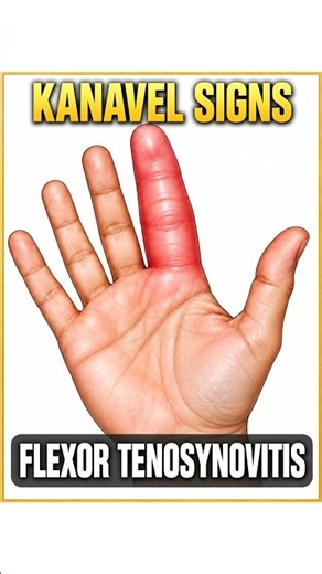 Kanavel Signs for Flexor Tenosynovitis 🚨 #Meded #Surgery #handsurgery #emergencymedicine