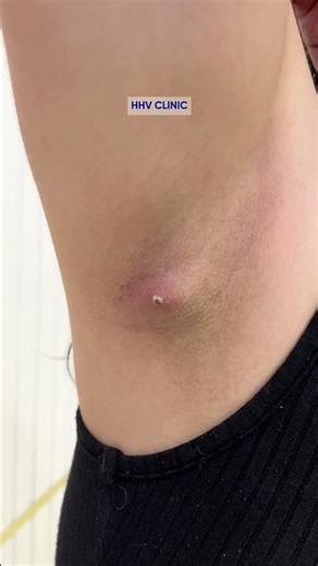 Nhọt áp xe ở nách – Dấu hiệu viêm mủ sâu, chớ tự ý nặn kẻo để lại sẹo và nhiễm trùng nặng.