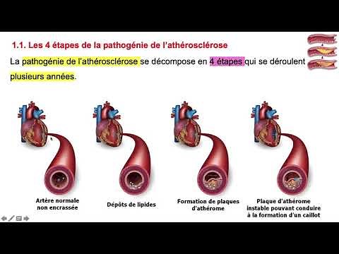 vidéo 1 sur le chapitre C.4. 3. l'athérosclérose et les insuffisances coronariennes