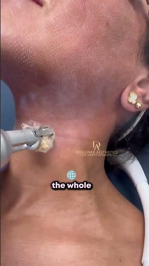 Is your neck giving away your age after face resurfacing? #ErbiumLaser #antiaging #skinrejuvenation