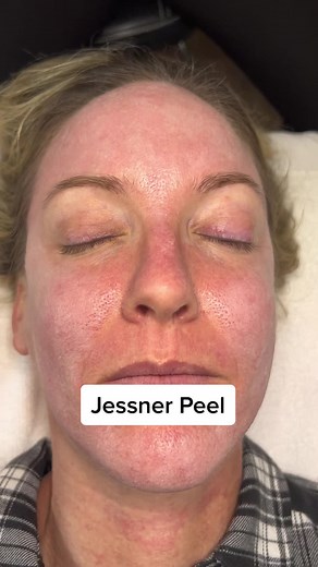 Discover the Benefits of a Jessner Peel for Stubborn Acne and Aging Skin