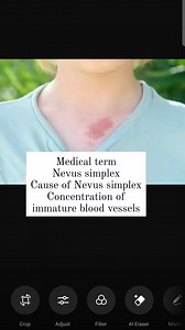 Nevus simplex Cause of Nevus Simplex Concentration of immature blood vessels #yousafpalmist #palmistry #medical #hand #palmist | Yousaf Palmist