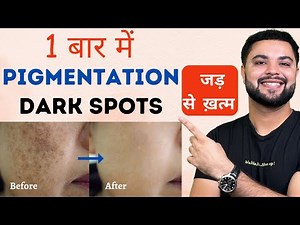 Pigmentation, Melasma & काले धब्बे (Dark Spots) होंगे जड़ से ख़त्म 1 बार में