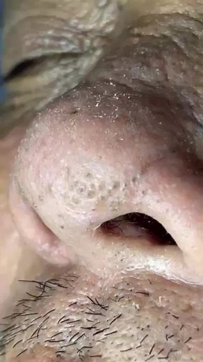 Effective Treatments for Acne and Blackheads on Nose