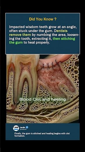 How Wisdom Teeth Are Removed (Step by Step)