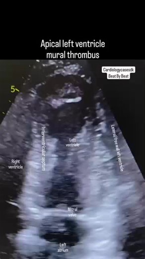 Sometimes you don't need SonoVue contrast to confirm a mural thrombus. This is a patient with earlier anterior myocardial infarction🫀. Remember the treatment can be low molecular weight heparin and when INR > 2 Warfarin or DOACs treatment. Have you seen a mural thrombus before??🤔 #cardiologycasesdk #muralthrombus #thrombus #trombe #cardiology