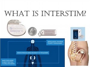 What is InterStim?
