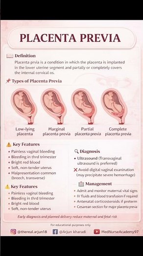 Placenta Previa Explained | Types, Features, Diagnosis & Management | OB GYN Quick Revision