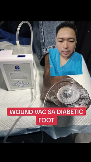 Wound Vac para Pie Diabético: Cuidado y Sanación