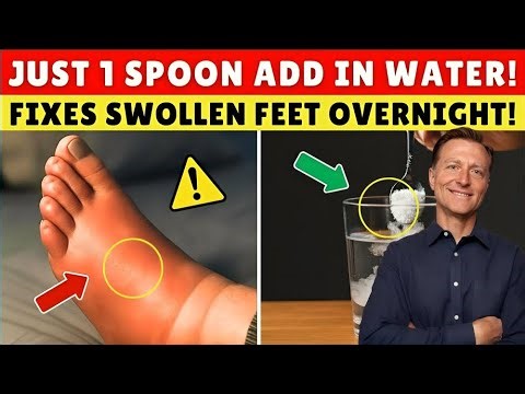 7 Bedtime Remedies That Flush Foot Swelling Overnight | Dr. Eric Berg