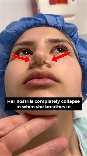 Plastic Surgeon Dr. Kassir | Do your nostrils collapse when you breathe in? That’s a classic case of Nasal Valve Collapse ✨ What is Nasal Valve Collapse? Nasal Valve... | Instagram