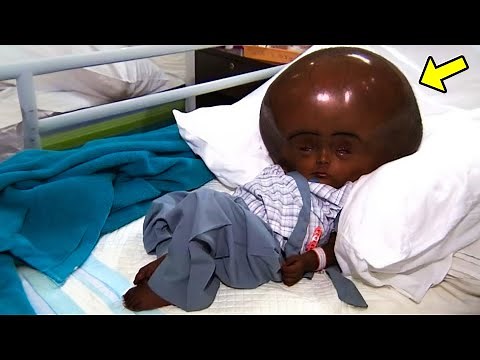 Remember This Girl With World's Biggest Head? This Is What Happens To Her