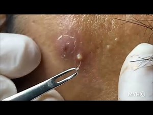 Blackheads Extractions l Cystic acne left him in Extreme Pain EP.10
