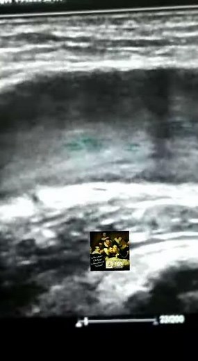 Rouleaux flow ultrasound by Dr.Haissam Aref, DMS, MSc, MD ultrasound