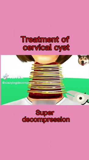 #decompression Treatment of cervical cyst